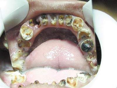 离异男性梦见牙齿掉落的多重寓意解析插图