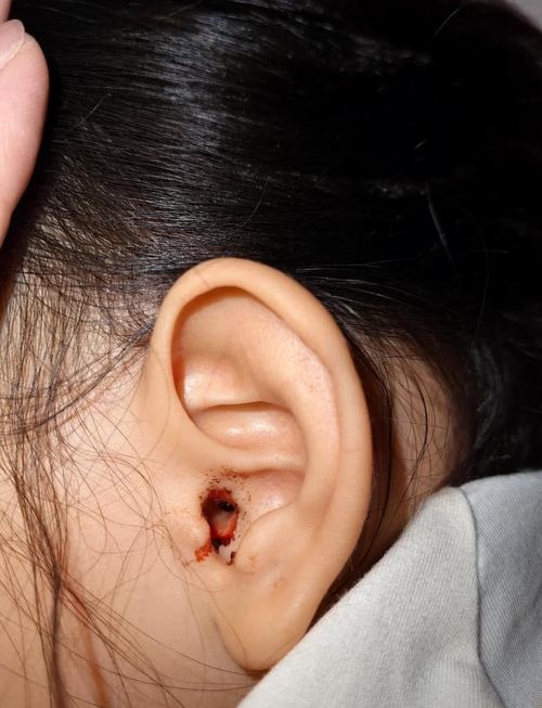 梦见耳朵流血预示什么插图