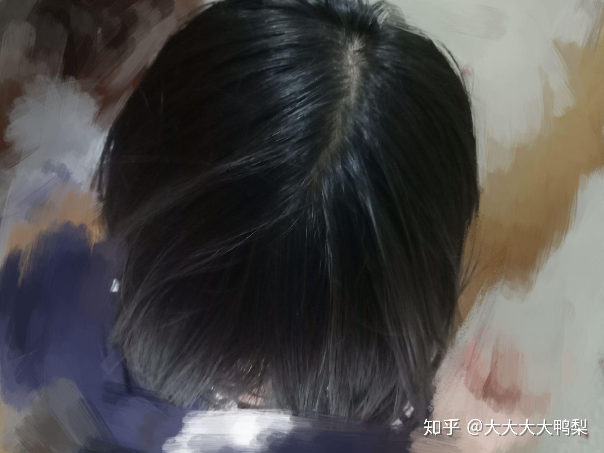 梦见秃顶寓意解析插图