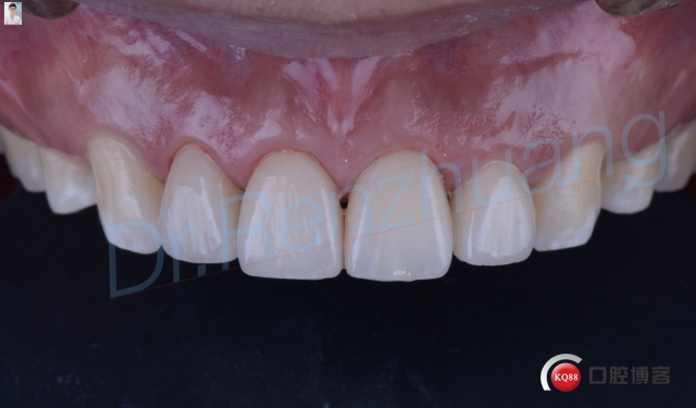 梦见牙齿脱落，象征人生转变与内心不安。插图