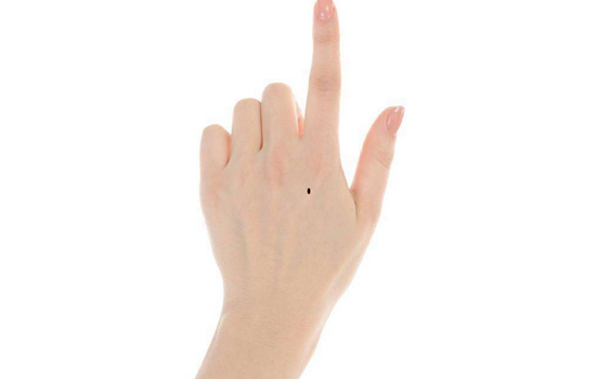 手背痣图解插图