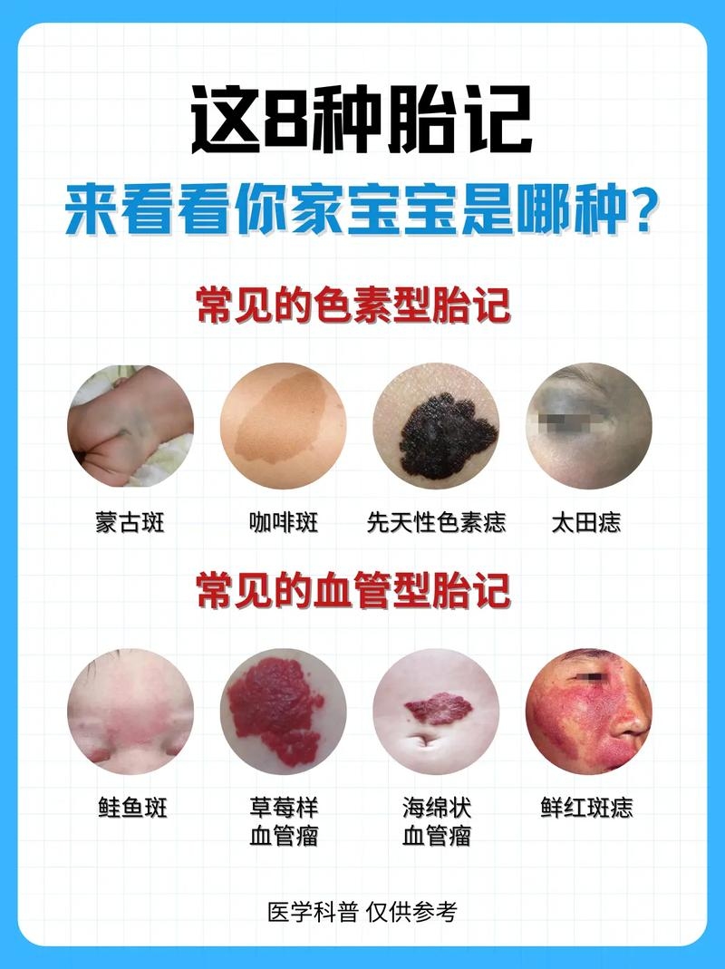 婴儿胎记的常见类型与解析插图