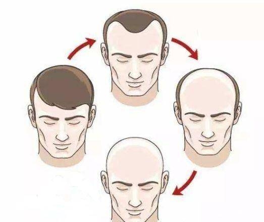 男人梦见掉发秃顶的多种解读插图