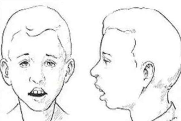 关于没有鼻子的人，影响与健康运势分析-红迪亚