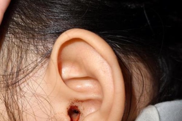 梦见耳朵流血预示什么-红迪亚