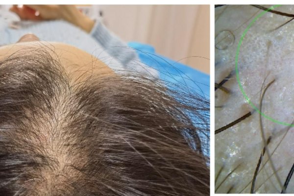 梦见秃发-红迪亚