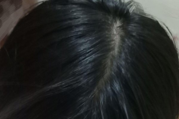 梦见秃顶寓意解析-红迪亚