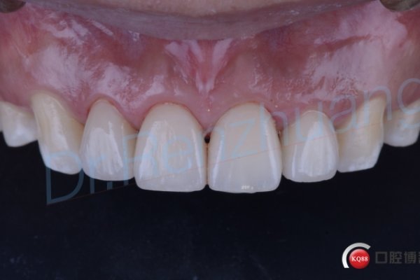 梦见牙齿脱落，象征人生转变与内心不安。-红迪亚