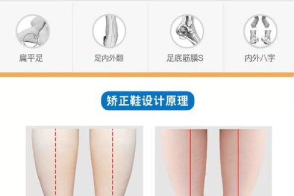 内八字矫正鞋有效纠正轻度畸形-红迪亚