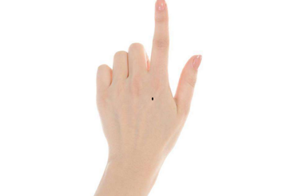 手背痣图解-红迪亚