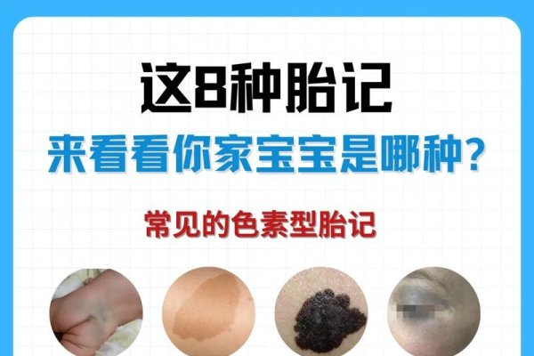 婴儿胎记的常见类型与解析-红迪亚