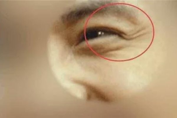 鱼尾纹上翘面相-红迪亚